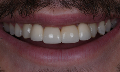 dental crowns in Winston Salem, NC- After Photo