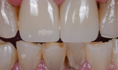 root canal in winston salem- after photo