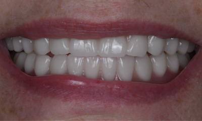 same day dentures in winston salem- after photo