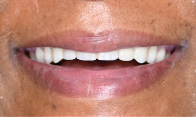 IV Sedation dental case- after photo
