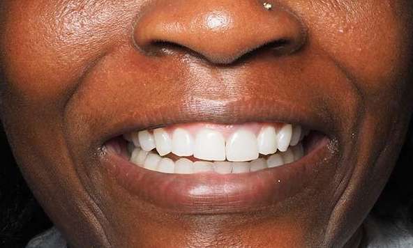 Close up view of black womans mouth after Winston-Salem Crowns