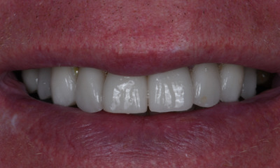 After treatment - Thought process Replacing Chipped, Discolored Teeth with Veneers Under IV Sedation
