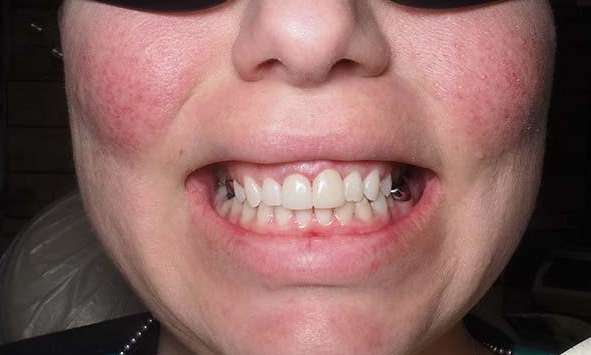 Close up of mouth after crowns in winston salem