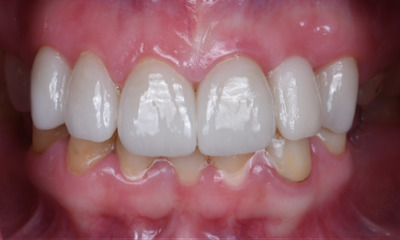 implants in winston salem, after photo