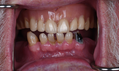 Before treatment - A New Smile with Full Arch Dental Implants