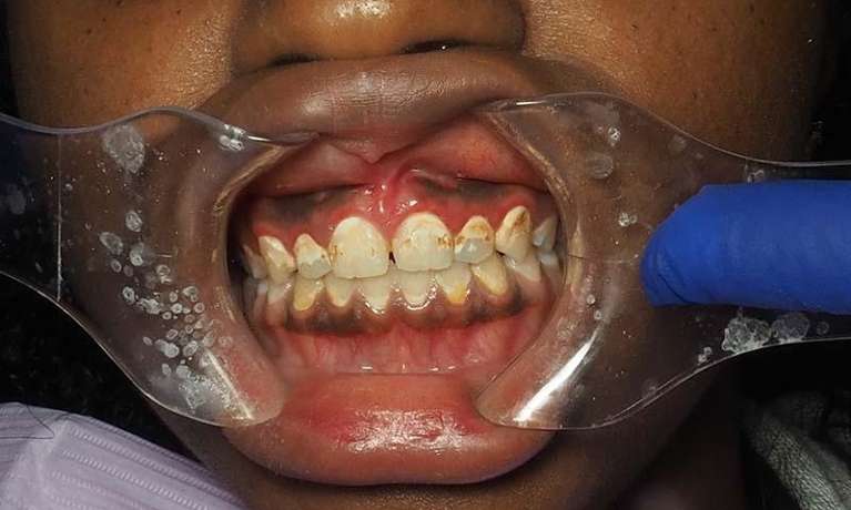 composite veneers winston salem- before photo