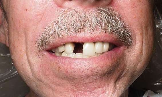 Antieor-implant-Before-Image