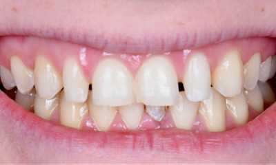 dental crowns in Winston Salem, NC- Before Photo