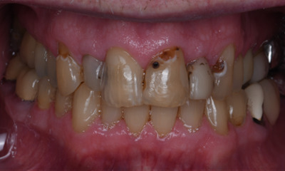 Custom dental crowns- before photo