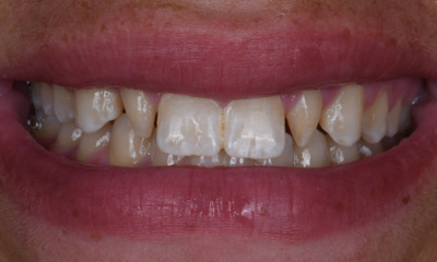 dental crowns in Winston Salem, NC- Before Photo