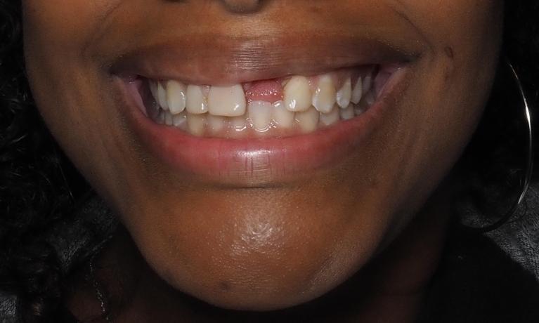Front-Tooth-Dental-Implants-Before-Image