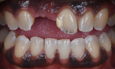 dental emergency- before photo