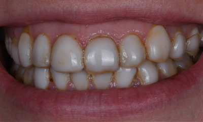 Before treatment - Replacing 12 Outdated Veneers for a Refreshed, Age-Appropriate Smile