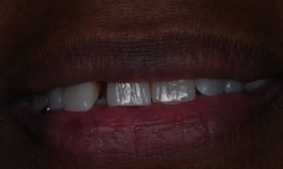 dental bridge in winston salem- before photo