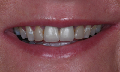 Before treatment - Replacing Old Metal Crowns with 6 New Custom Crowns