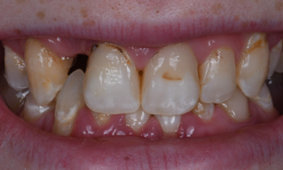 dental crowns in Winston Salem, NC- Before Photo