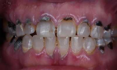 Before treatment - Restoring a Healthier, More Confident Smile with Composite Fillings