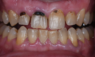 sedation dentistry case in Winston Salem, NC- Before Photo