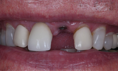 implants in winston salem, before photo