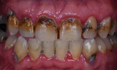 dental fillings in Winston Salem, NC- Before Photo