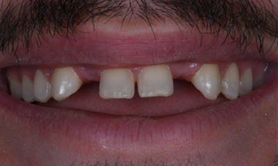dental crowns in Winston Salem, NC- Before Photo