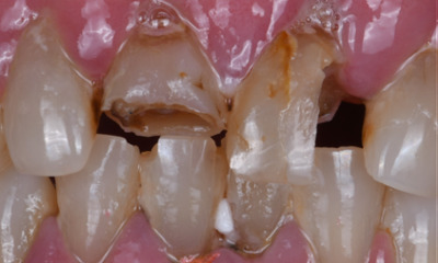 root canal in winston salem- before photo