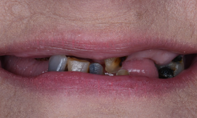 same day dentures in winston salem- before photo