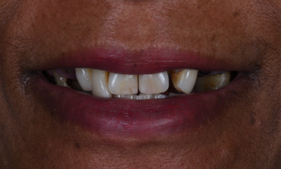 IV Sedation dental case- before photo