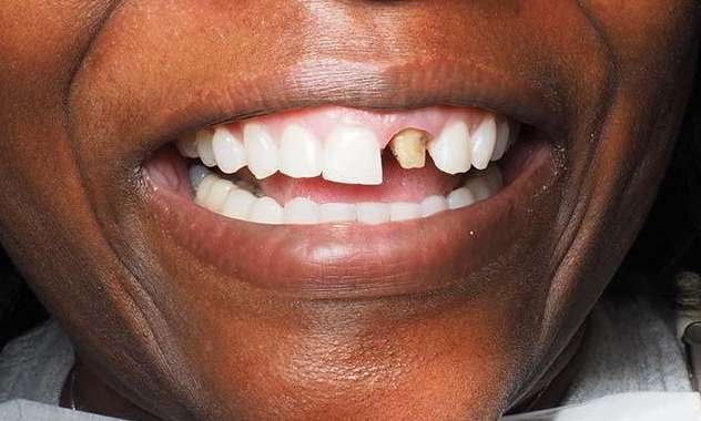 Close up view of black womans mouth before crowns in Winston-Salem