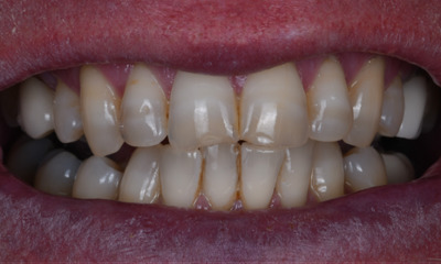 Before treatment - Thought process Replacing Chipped, Discolored Teeth with Veneers Under IV Sedation