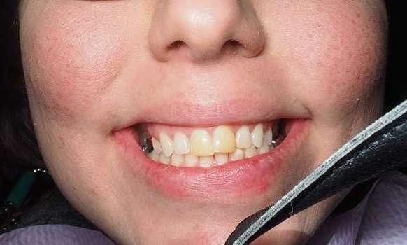 Close up of mouth before winston salem Crowns