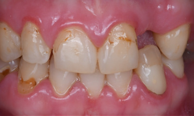 implants in winston salem, before photo